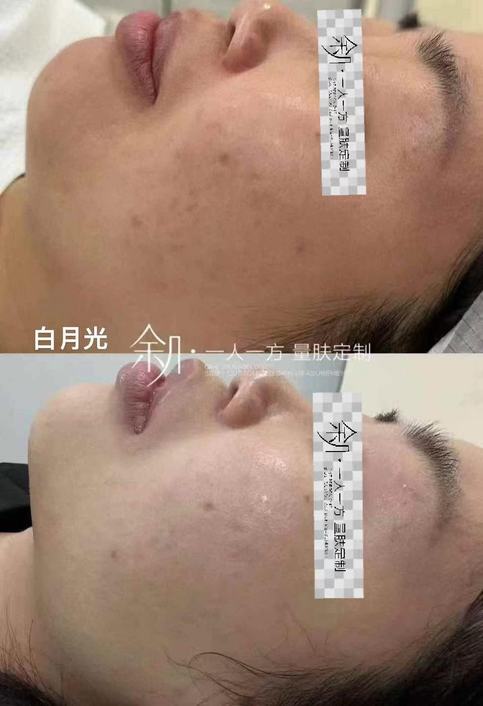 皮肤管理案例