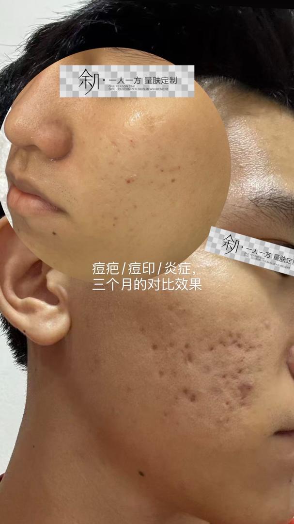 皮肤管理案例