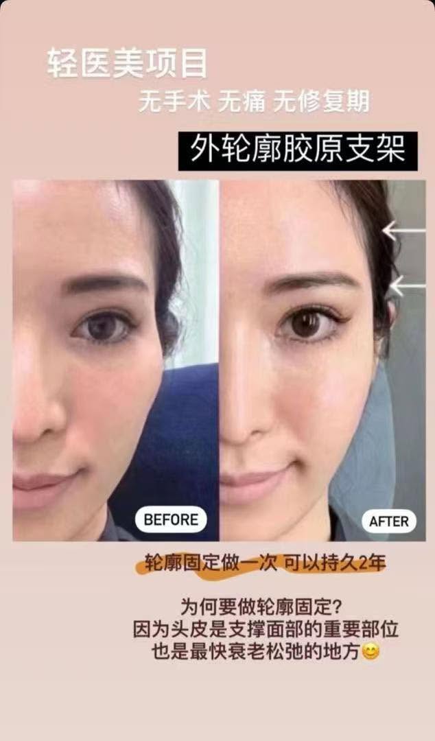 下颌线模糊